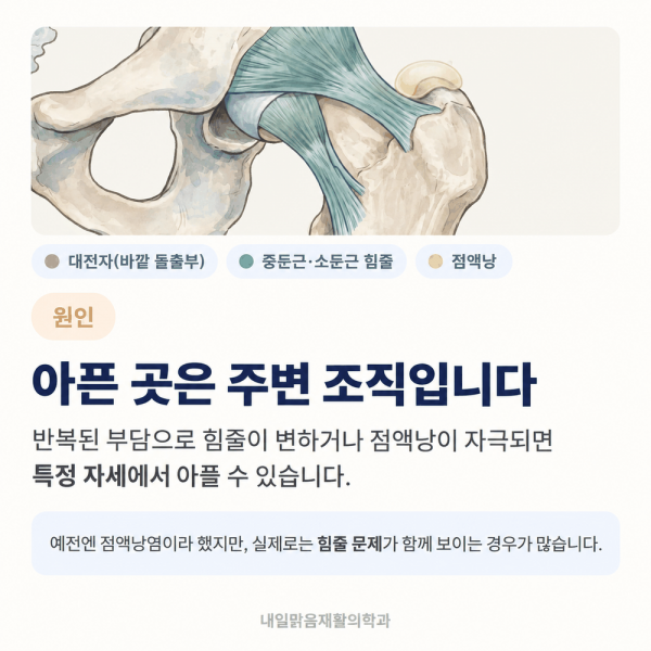 골반 바깥쪽 통증의 힘줄과 점액낭 원인 안내 카드